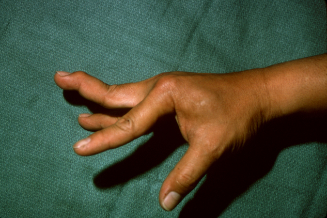 swan-neck-deformity-hand-surgery-resource
